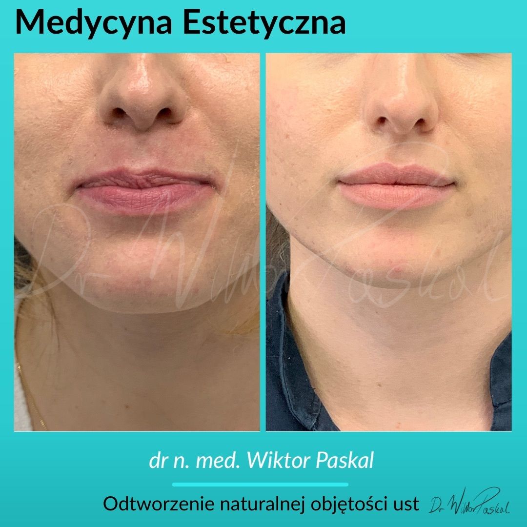 Powi Kszanie Ust Przed I Po Estheticon Pl Estheticon Pl