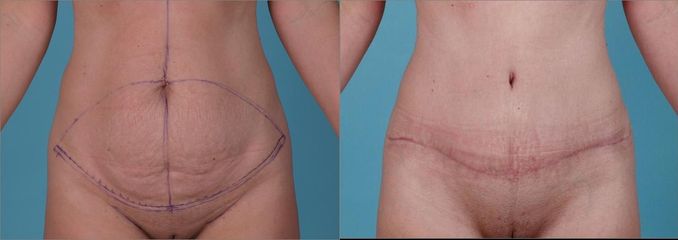 Adbominoplastika a liposukce boků