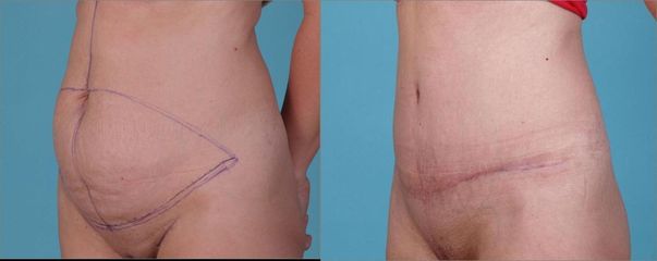 Abdominoplastika a liposukce boků