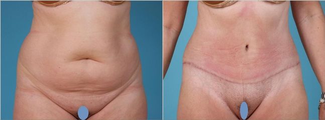 Lipoabdominoplastika