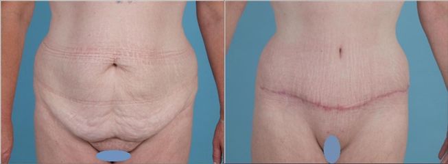 Abdominoplastika