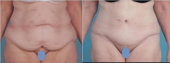 Abdominoplastika
