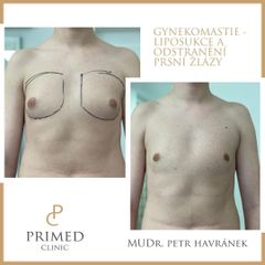 Gynekomastie - MUDr. Petr Havránek