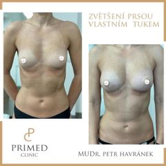 Lipofilling prsou - MUDr. Petr Havránek