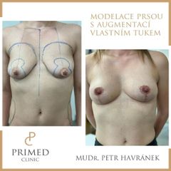 Modelace prsou - MUDr. Petr Havránek