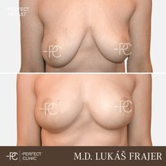 Modelace prsou - Perfect Clinic - centrum estetické medicíny