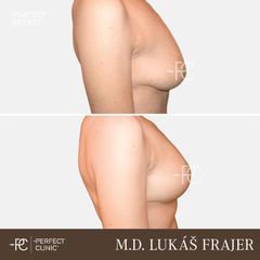 Modelace prsou - Perfect Clinic - centrum estetické medicíny