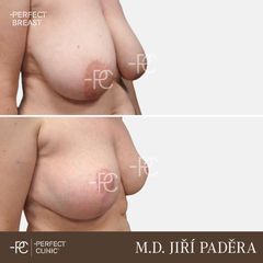 Zmenšení prsou - Perfect Clinic - centrum estetické medicíny