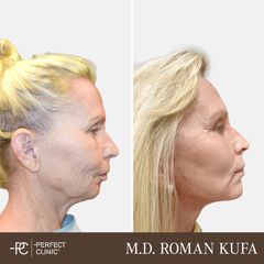 Rhinoplastika - Perfect Clinic - centrum estetické medicíny