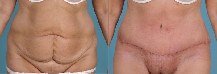 Abdominoplastika a liposukce boků