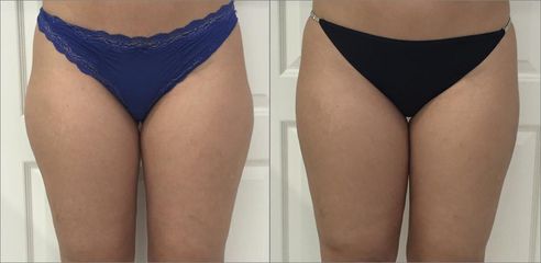 Liposukce tumescentní