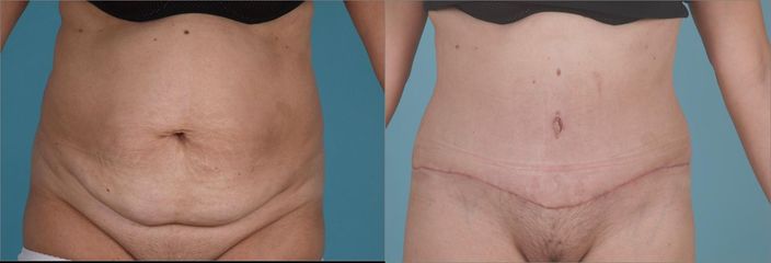 Abdominoplastika
