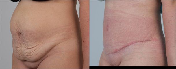Abdominoplastika