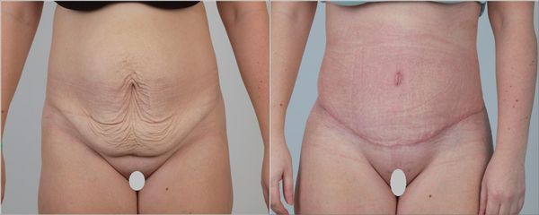 Abdominoplastika