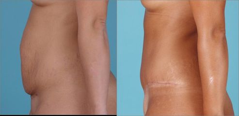 Abdominoplastika