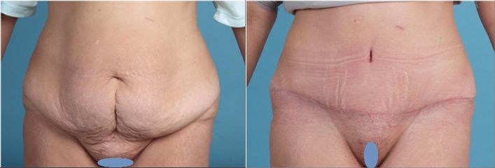 Abdominoplastika