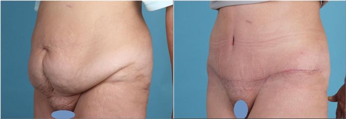 Abdominoplastika