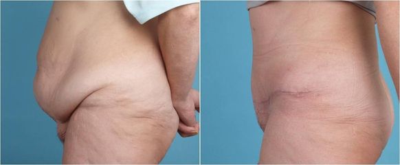 Abdominoplastika
