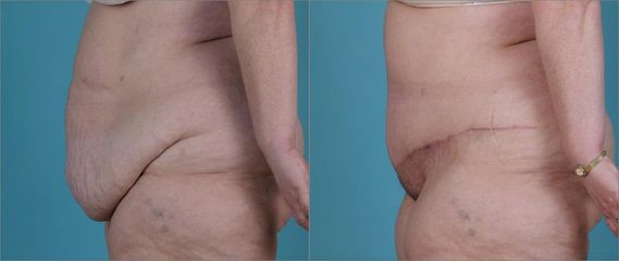 Abdominoplastika