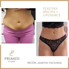 Abdominoplastika - MUDr. Martin Paciorek