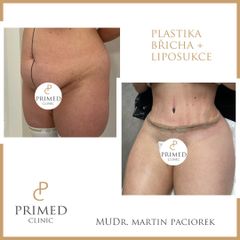 Abdominoplastika - MUDr. Martin Paciorek