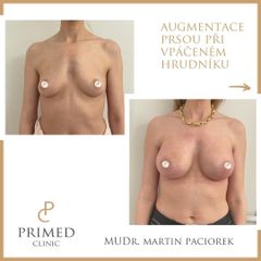 Zvětšení prsou - MUDr. Martin Paciorek