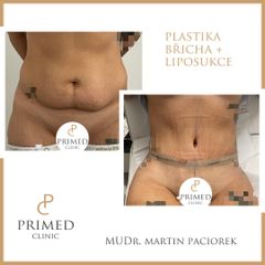 Abdominoplastika - MUDr. Martin Paciorek