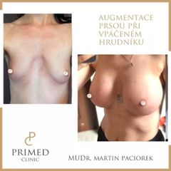 Zvětšení prsou - MUDr. Martin Paciorek