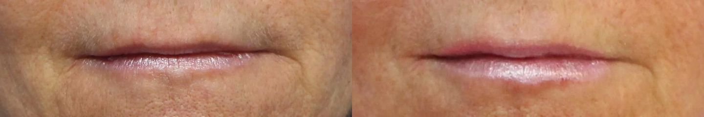 Belotero contour + shape, Restylane LYPS