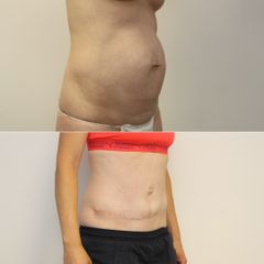 Abdominoplastika - GIA Clinic s.r.o.