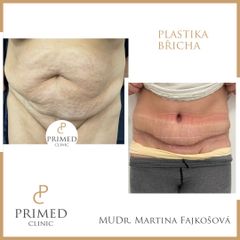 Abdominoplastika - MUDr. Martina Fajkošová