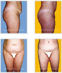 abdominoplasika