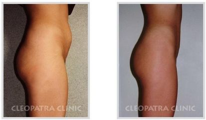 miniabdominoplastika