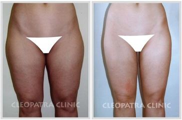 liposukce stehen-zevní a vnitřní a kolen