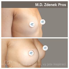 Zvětšení prsou - MUDr. Zdeněk Pros - Perfect Clinic