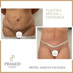 lipoabdominoplastika