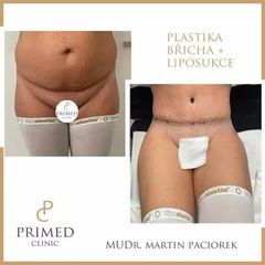 plastika bricha