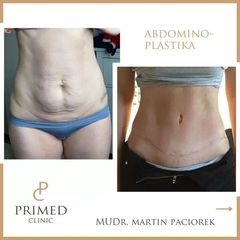 abdominoplastika PRIMED Clinic