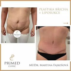 abdominoplastika PRIMED Clinic