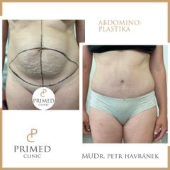 Abdominoplastika - PRIMED Clinic