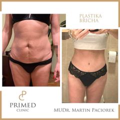 Abdominoplastika - PRIMED Clinic