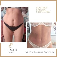 Abdominoplastika - PRIMED Clinic