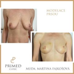 Modelace prsou - PRIMED Clinic