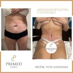 Abdominoplastika - PRIMED Clinic