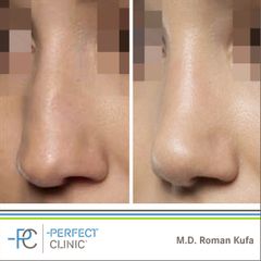 Plastika nosu (Rhinoplastika) - MUDr. Roman Kufa - Perfect Clinic