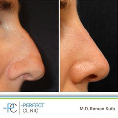 Plastika nosu (Rhinoplastika) -MUDr. Roman Kufa - Perfect Clinic
