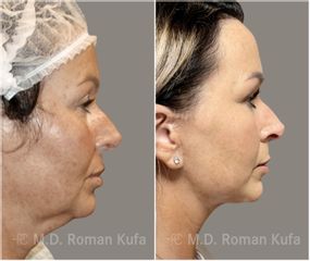 Facelift  - MUDr. Roman Kufa - Perfect Clinic