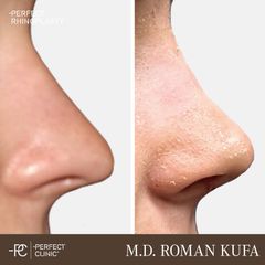 Rhinoplastika - MUDr. Roman Kufa - Perfect Clinic