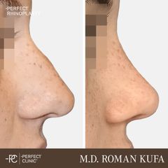 Rhinoplastika - MUDr. Roman Kufa - Perfect Clinic