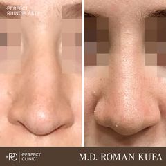 Rhinoplastika - MUDr. Roman Kufa - Perfect Clinic